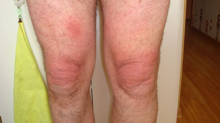 artróza kolenních kloubů