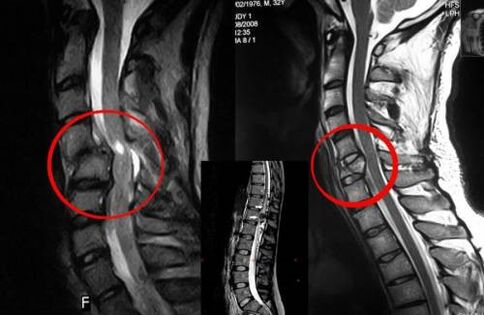 Komprese míchy - indikace k operaci